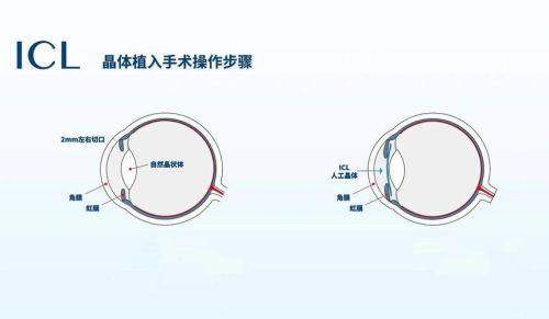 深圳普瑞眼科医院（星耀店）特色项目及技术优势
