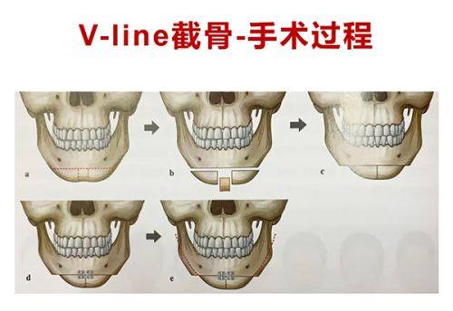 韩国Bommaru医院真人口碑评价怎么样？