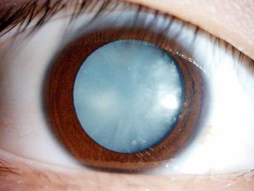 平煤神马医疗集团总医院眼科特色项目及技术优势