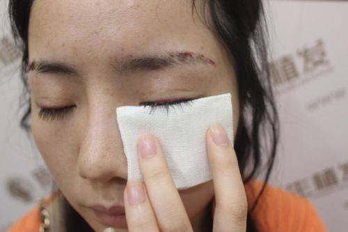 昆明新生植发收费价格表/收费标准