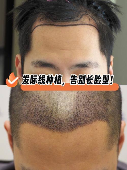 昆明新生植发真人口碑评价怎么样？