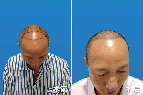 昆明新生植发详细的预约挂号方式及流程