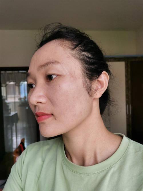 马小萍医生技术优势