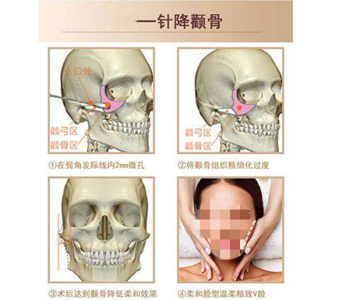深圳明莱医疗美容诊所真人口碑评价怎么样？